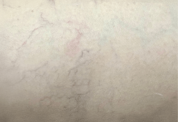 Μετά τη θεραπεία αποτρίχωσης