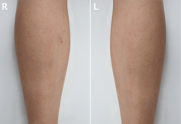 Μετά τη θεραπεία αποτρίχωσης