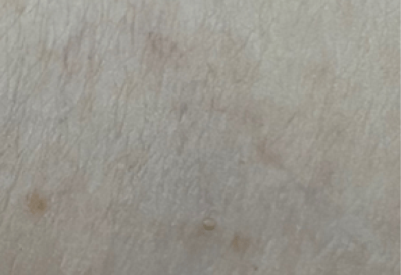 Μετά τη θεραπεία αγγειακών βλαβών