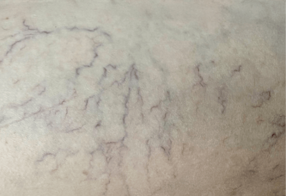 Πριν τη θεραπεία αποτρίχωσης