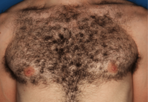 Πριν τη θεραπεία μελαγχρωματικών βλαβών