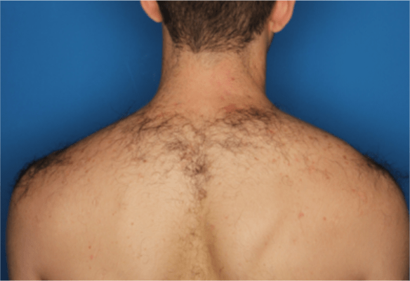 Πριν τη θεραπεία αποτρίχωσης