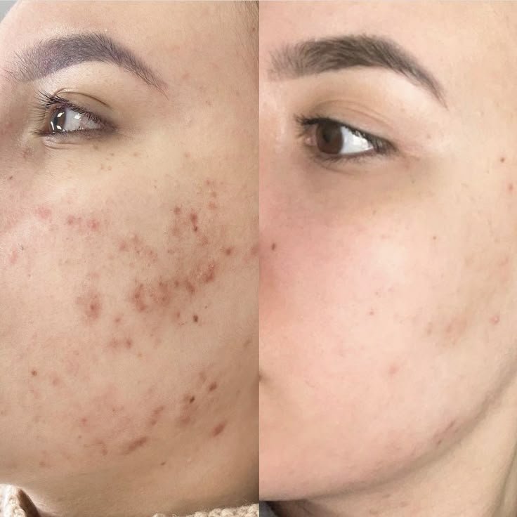 Χημικό πίλινγκ — πριν και μετά θεραπεία MB Aesthetic Clinic