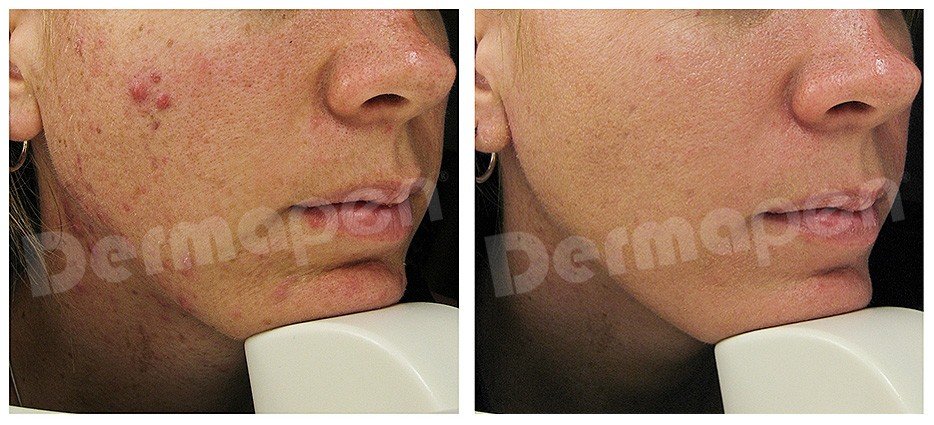 DERMAPEN 4 results for acne scars