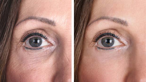 Μεσοθεραπεία προσώπου στο MB Aesthetic Clinic Σαλαμίνα