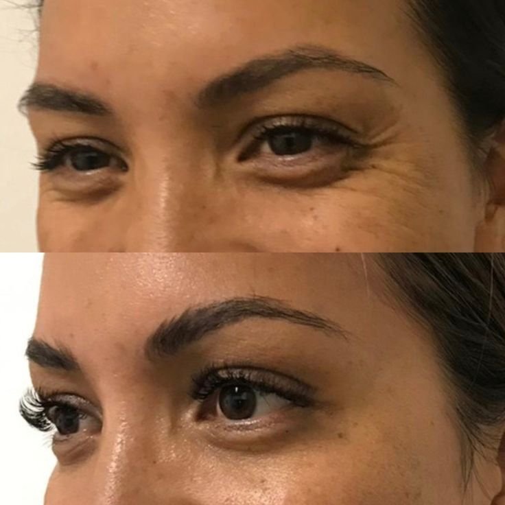 Skin Boosters θεραπεία στο MB Aesthetic Clinic Σαλαμίνα