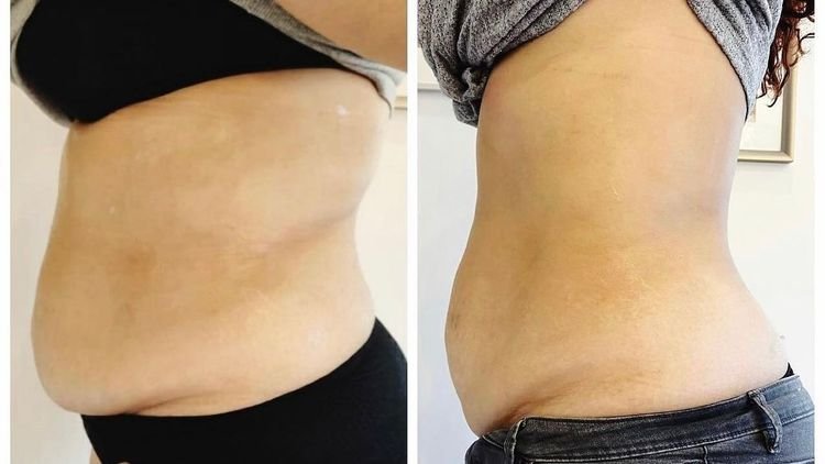 ZIONIC results after 10 sessions